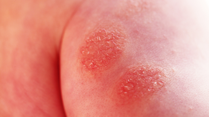 Dermatite Associada à Incontinência: Prevenção e Tratamento