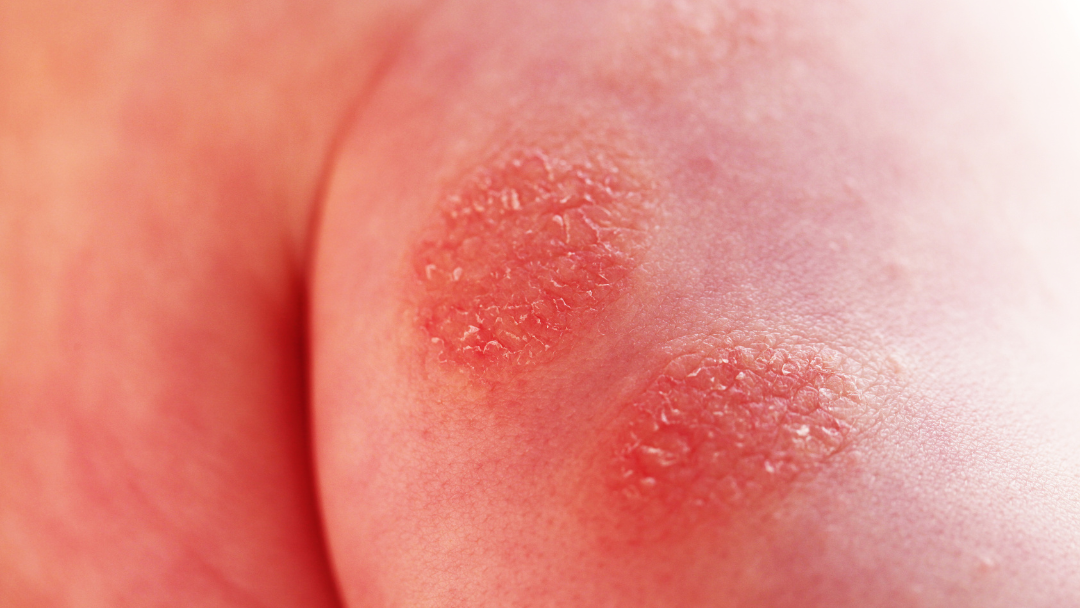 Dermatite Associada à Incontinência: Prevenção e Tratamento